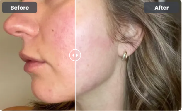 Glokore LED Skin Sculptor Benefits